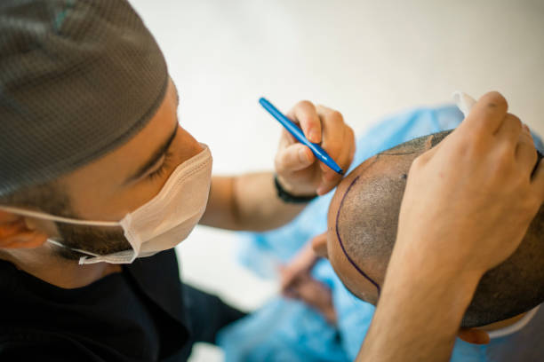 Haartransplantation - Möglichkeiten, Techniken und Kosten